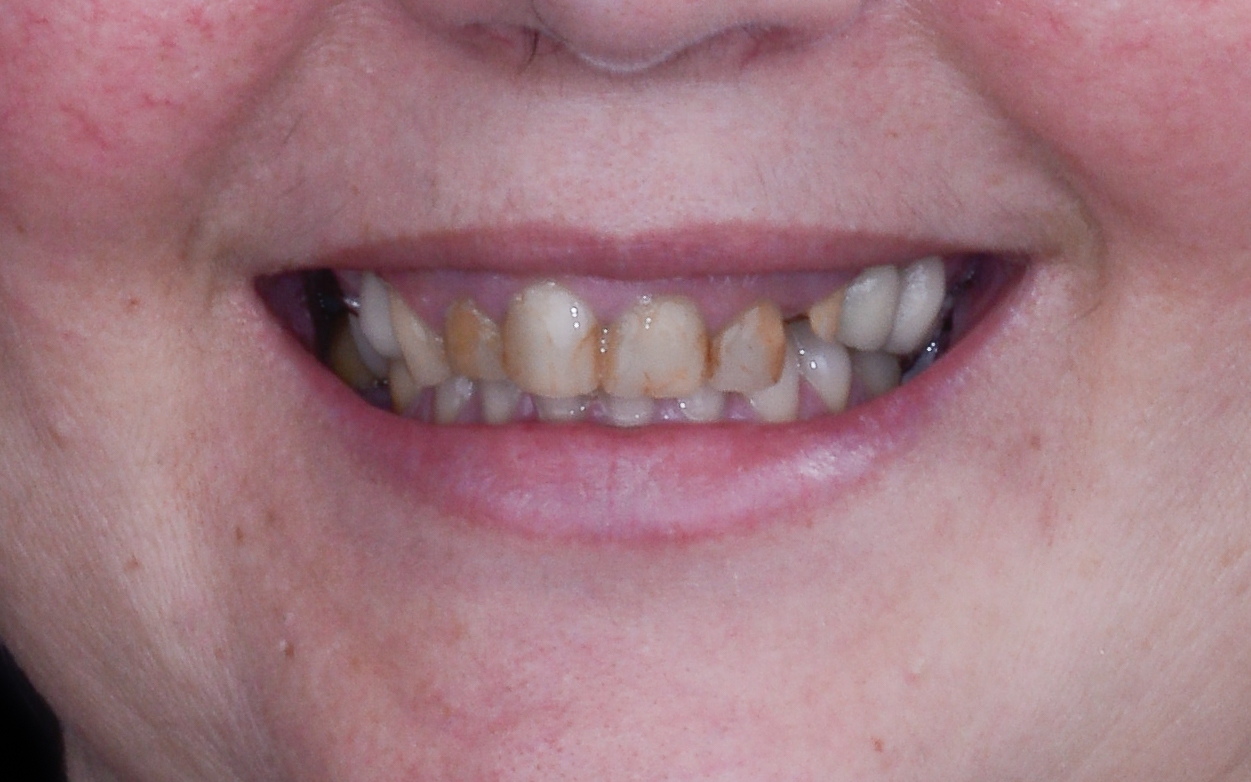 Before