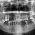 Perda óssea alveolar